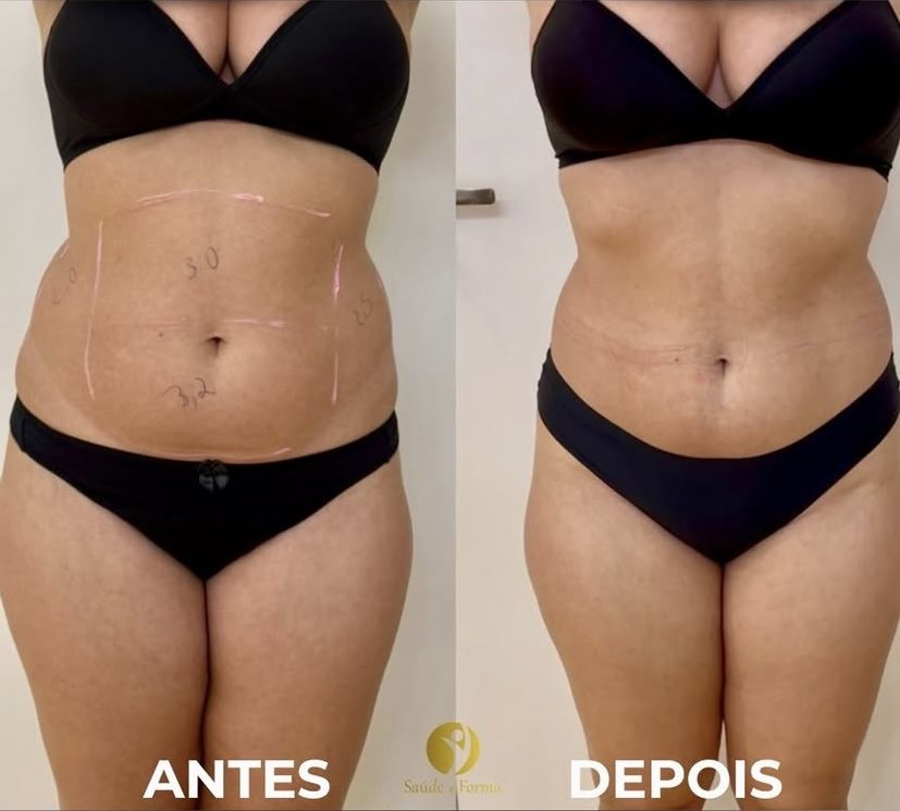 Resultado de contorno corporal, abdômen