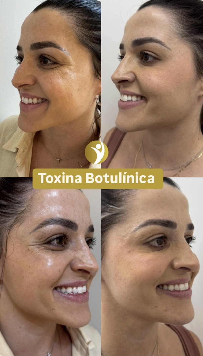 Resultado de toxina botulínica